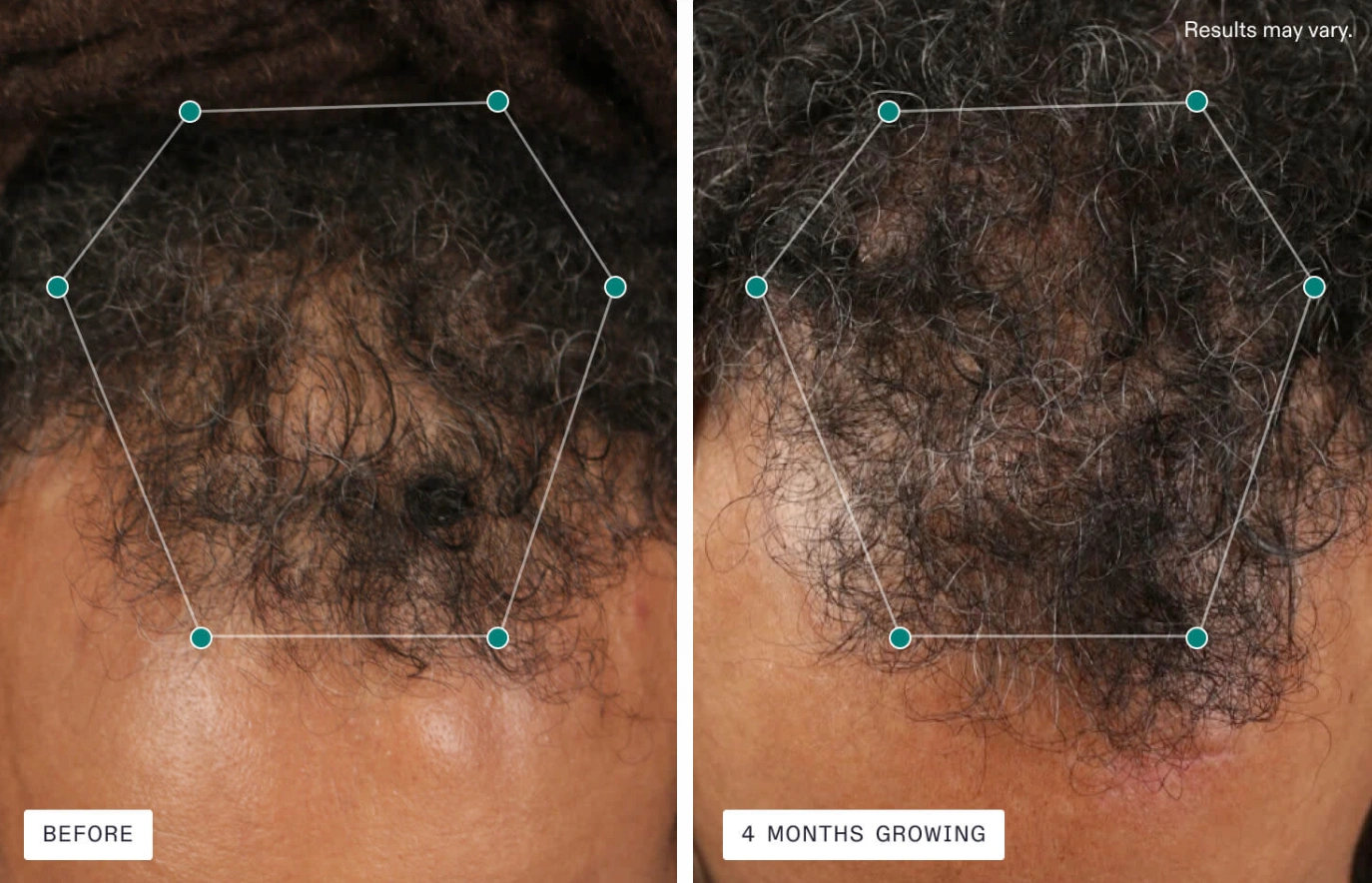 Nutrafol men's Balance 3 Month Supply | Ashburn, VA | Amy Aesthetics