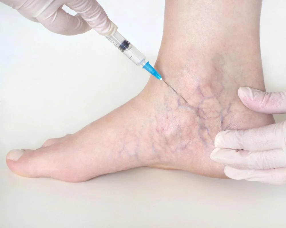 Sclerotherapy Treatments in Ashburn, VA | Amy Aesthetics